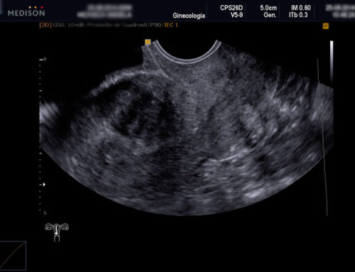 UTILIDAD DE LA TECNOLOGIA 3D EN LA ECOGRAFÍA GINECOLÓGICA DE RUTINA